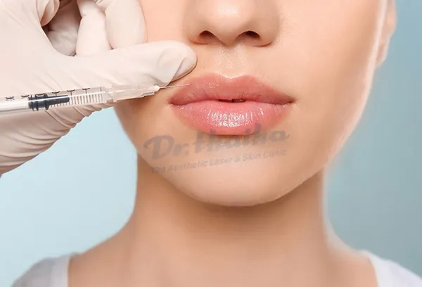 Biến chứng tiêm filler môi có thể gặp phải và biện pháp khắc phục