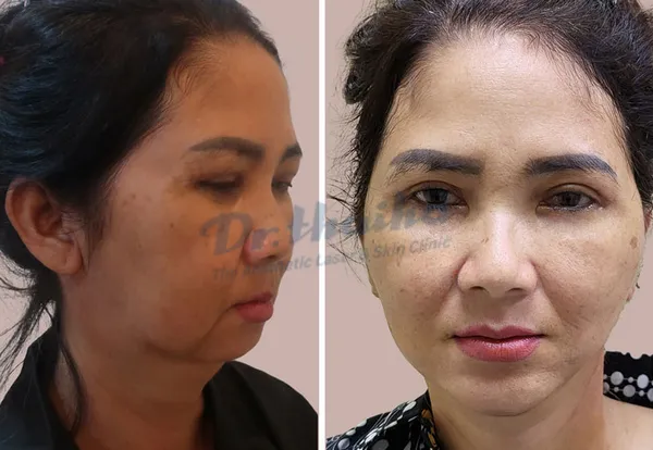 Thẩm mỹ viện căng da mặt uy tín có bác sĩ đầu ngành tại Hà Nội