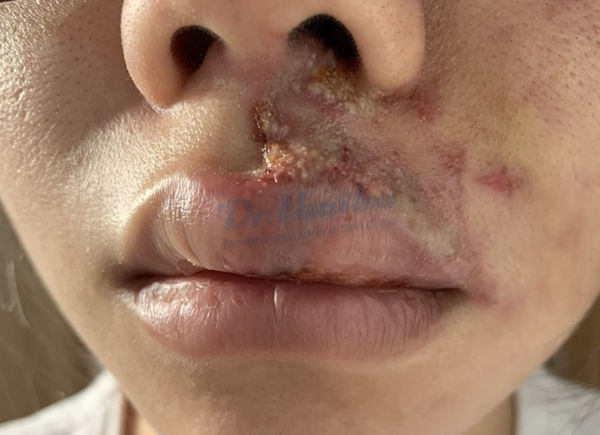 Biến chứng tiêm filler môi có thể gặp phải và biện pháp khắc phục