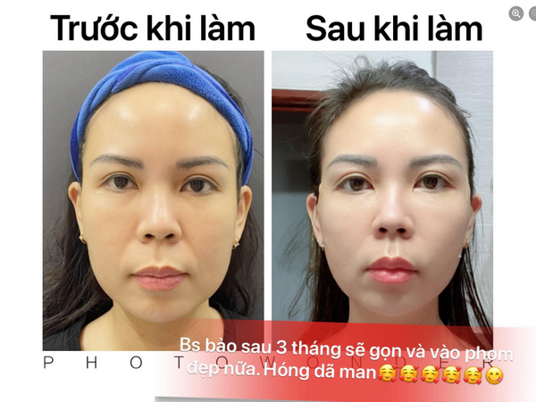 Hình ảnh trước và sau khi căng/ cấy chỉ collagen da mặt