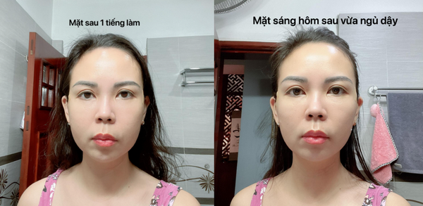 Hình ảnh trước và sau khi căng/ cấy chỉ collagen da mặt