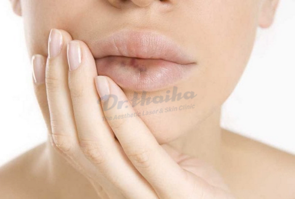 Tiêm filler môi có ảnh hưởng gì không? Tác dụng phụ thường gặp