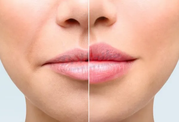 Tiêm filler môi có ảnh hưởng gì không? Tác dụng phụ thường gặp